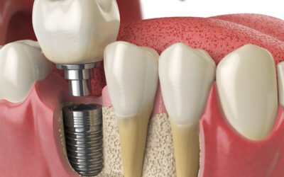 What Are Dental Implants? A Simple Guide